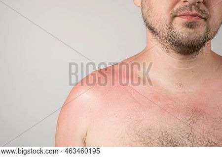 Skin Of A Person With Sunburn, Redness Of The Skin, Close-up, Space For Text.