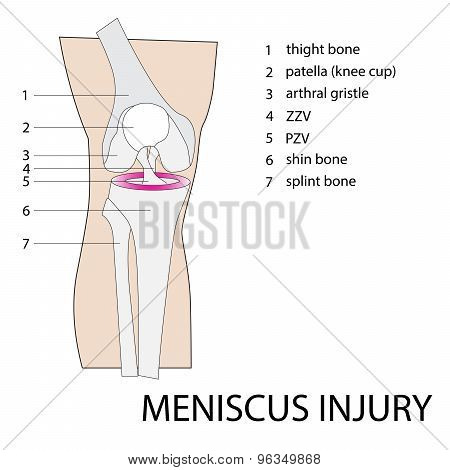 meniscus injury