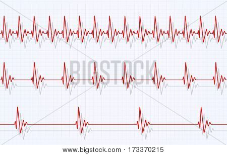 Speed Of Heart Beating