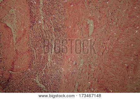 Cells of a human ovary with Ovarian cancer cells under the microscope.