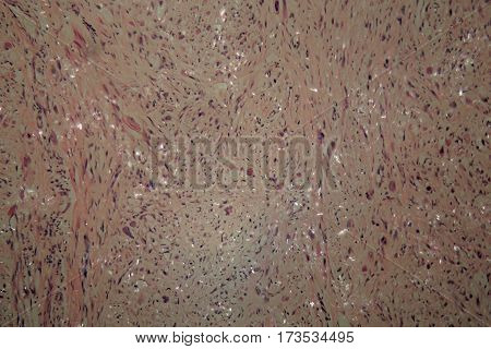 Cells of testicular cancer under a microscope.