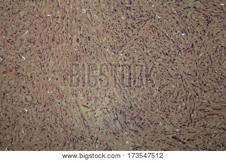 Cells of testicular cancer under a microscope.