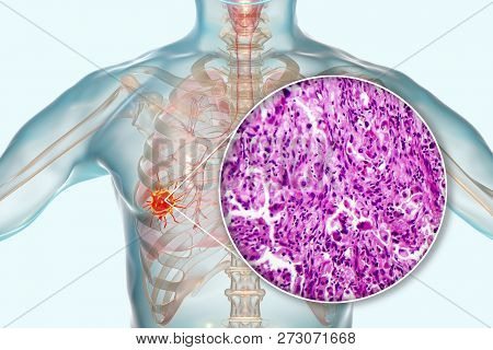 Lung Cancer, 3d Illustration And Photo Under Microscope. Histopathology Light Micrograph