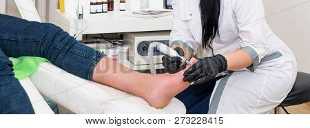 Podology Treatment. Podiatrist Treats Foot. Podiatry Doctor Or Dermatologist Treats The Patient In M