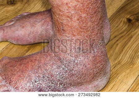 Close-up Of Skin With Varicose Veins On Senior Male Leg. Concept Of Dry Skin, Old Senior People, Var