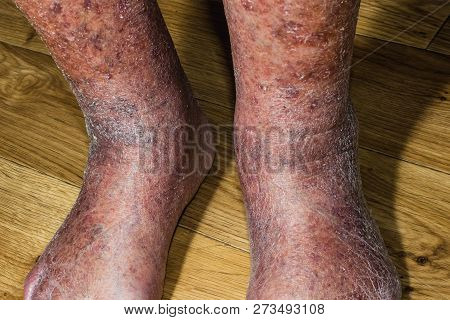 Close-up Of Skin With Varicose Veins On Senior Male Leg. Concept Of Dry Skin, Old Senior People, Var