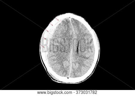 A Brain Ct Scan Of A Patient With Traumatic Brain Injury Showing Right Subdural Hemorrhage And Brain