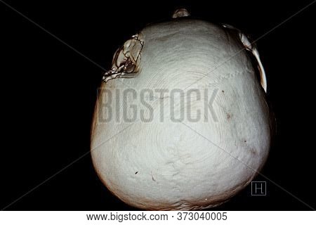 3-d Redering Film Of A Patient Skull With Traumatic Brain Injury Showing Compression Fracture Of Lef