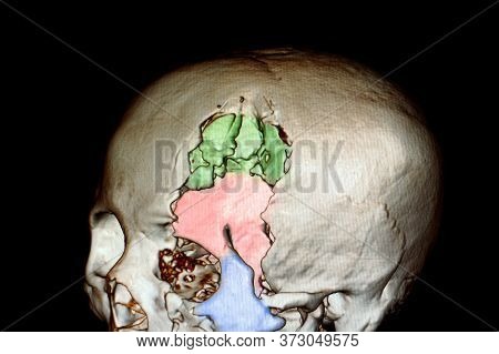 3 D Rendering Image Of A Skull Of A Patient With Depression Fractures Of Left Frontal, Temporal, Sup