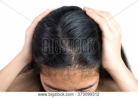 Women Head With Dandruff Caused By The Problem Of Dirty. Or Caused By Skin Disease Or Seborrheic Der