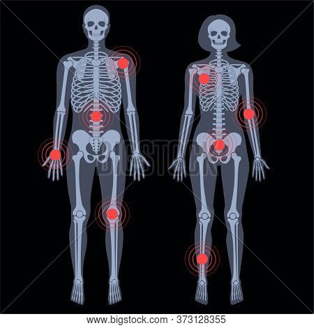 Human Woman And Man Skeleton Pain, Fracture Or Inflammation In Front On X Ray View. Vector Isolated 