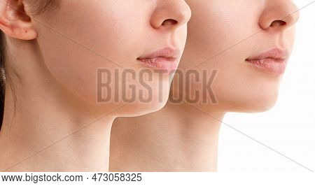 Female Double Chin Before And After Correction. Correction Of The Chin Shape Liposuction Of The Neck