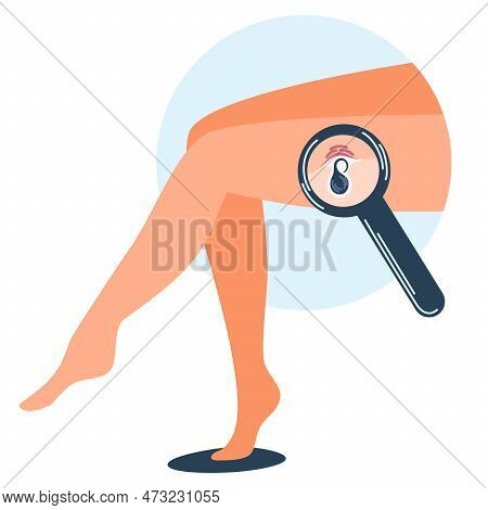 Women's Legs With Ingrown Hairs. Ingrown Hairs. Skin Problem, Inflammation. Comedones And Clogged Po