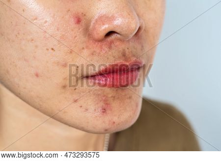 Cropped Shot Of Woman Having Problems Of Acne Inflamed On Her Face. Inflamed Acne Consists Of Swelli