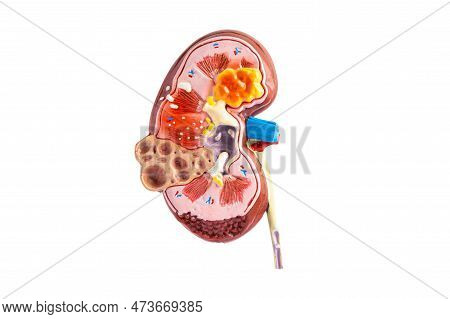 Kidney Disease, Chronic Kidney Disease Ckd, Model For Study Isolated On White Background With Clippi