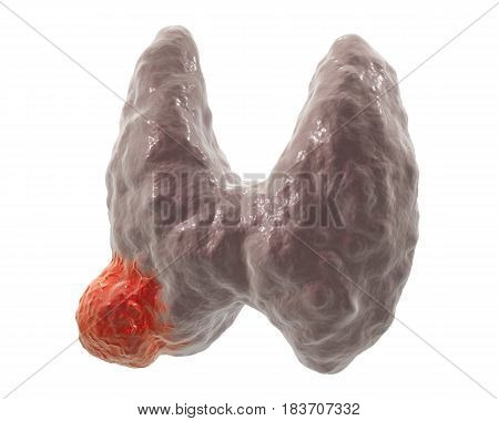 Thyroid cancer. 3D illustration showing thyroid gland with tumor isolated on white background