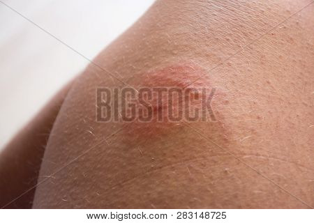 Photo Of Insect Bite On Skin. Double  Insect Bite (bee,wasp,horsefly) With Redness, Inflammation Are