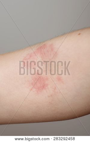 Diathesis On The Babys Hand Close-up. Problem Skin On The Arm.