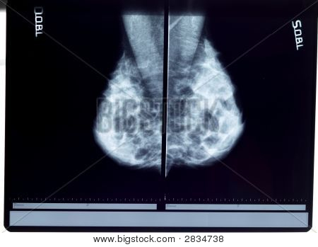 X-Ray mamogram