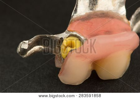 Image Of A Modern Arc  Denture With Attachment On A Black Background