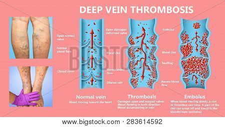 Deep Vein Thrombosis Or Blood Clots. Embolus. Structure Of Normal And Varicose Female Veins