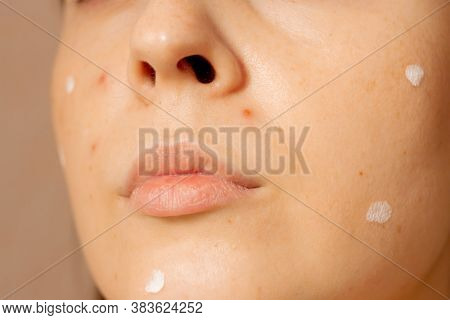 Skin Of Face Of Young Woman Is Affected By Chickenpox, Acne Defects