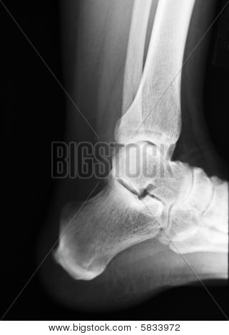Xray pięty