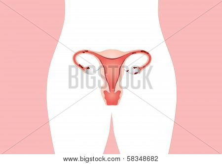 Endometriosis
