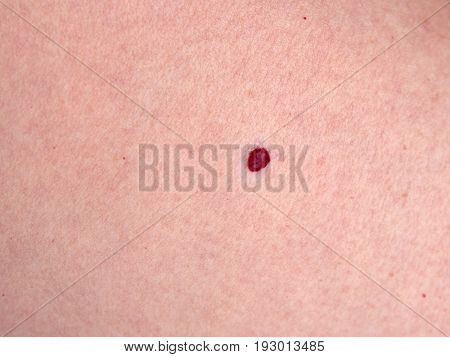 a little  red angioma on pink skin