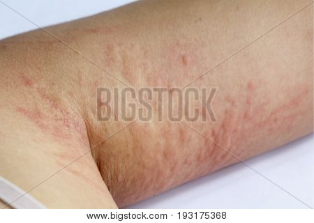 allergic rash skin of patient upper arm.