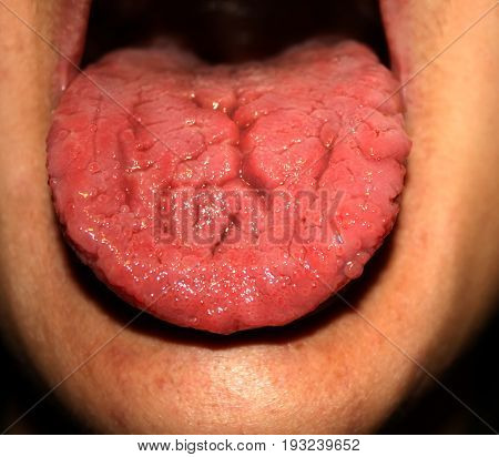 Candidiasis in the tongue. Fractured red tongue. Thrush