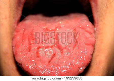 Candidiasis in the tongue. White coating. Thrush
