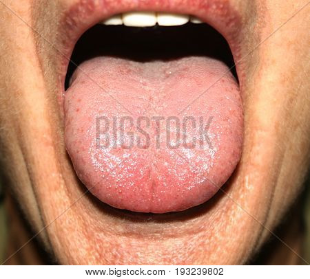 Candidiasis in the tongue. White coating. Thrush