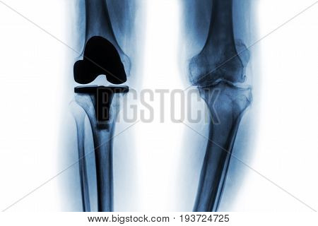 Film x-ray of osteoarthritis knee patient and artificial joint ( Total knee replacement ) . Isolated background .