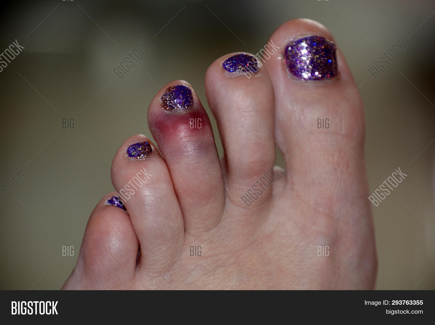 Black Blue Bruise On Image & Photo (Free Trial) Bigstock