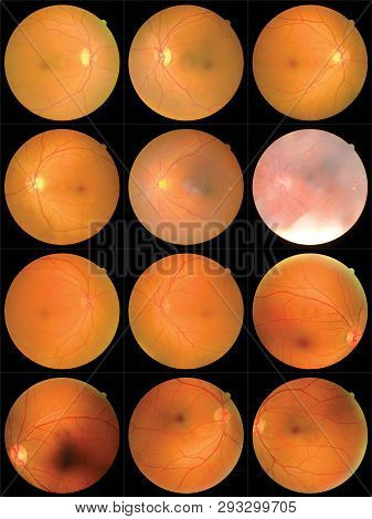 Collection Of Retinal Image  Of The Patient Taken With Retinal Photography Machine.
