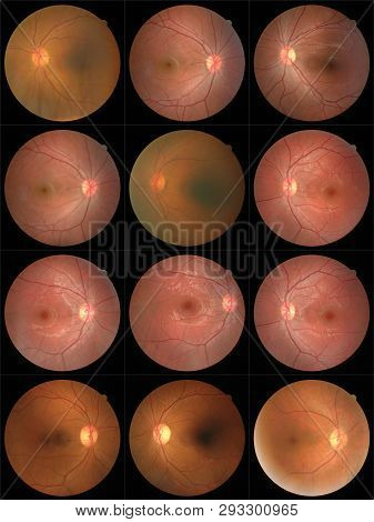 Collection Of Retinal Image  Of The Patient Taken With Retinal Photography Machine.