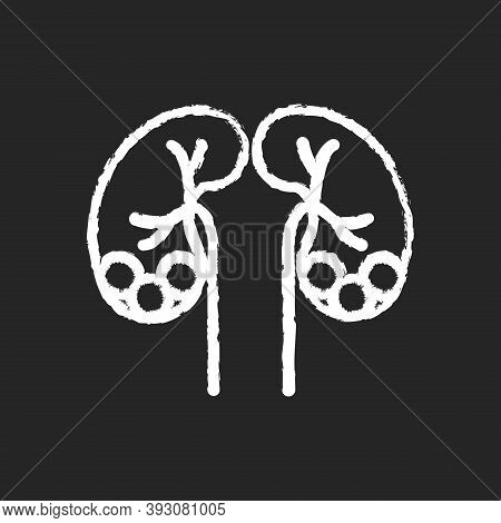 Kidney Stone Disease Chalk White Icon On Black Background. Dissolved Minerals And Salts. Urolithiasi