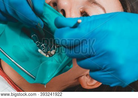 Restoration Of A Chewing Surface By Means Of Material For Filling With Photopolymer By Means Of The 