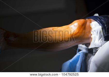 Traumatology Orthopedic Surgery Knee Arthroscopy