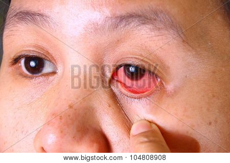 Eye Irritation