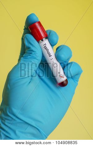 Typhoid blood sample