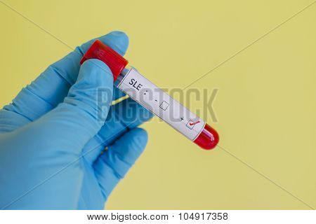 Systemic lupus erythematosus (SLE) positive