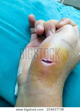 Dog Bite Fresh Wound Skin Waithing For Nurse And Doctor Treatment In Hospital. Big Hurt Fresh Punctu