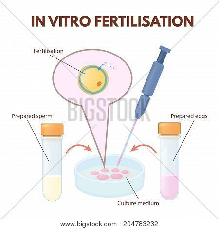 In vitro fertilization method - Co-incubation. Sperm and the egg are incubated in the laboratory