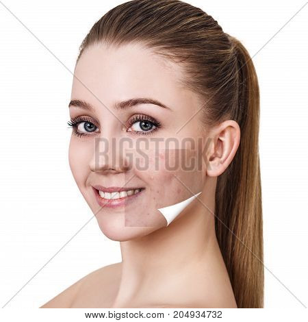 Layer with acne unstick from good healthy skin of young woman.