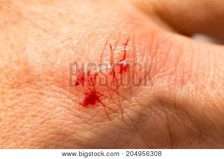 Blood on the skin from a cut with a knife .