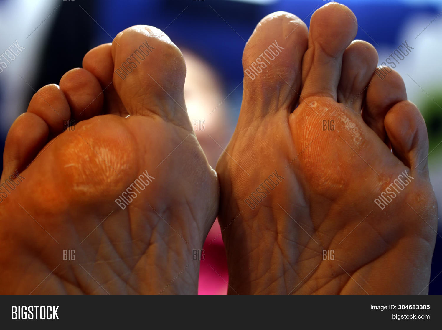 Corn On Foot. Foot Image & Photo (Free Trial) Bigstock