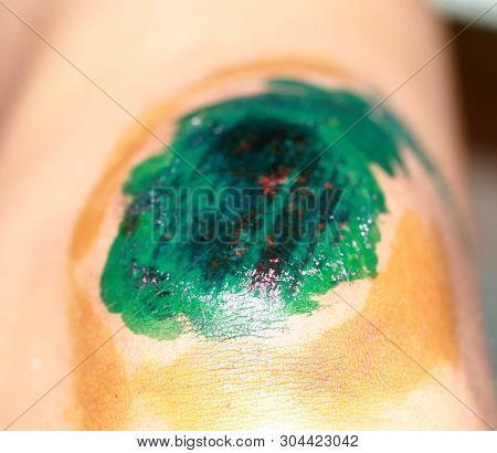 Healing Wound On The Knee. The Wound Treated With Brilliant Green. The Scab Will Climb