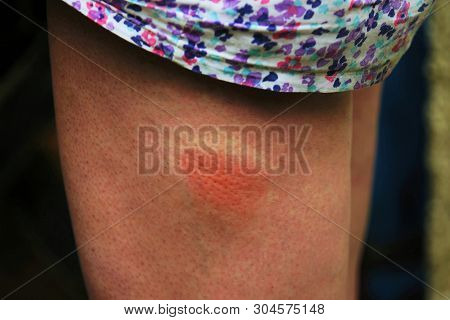Painful Allergic Reaction Caused By An Insect Bite